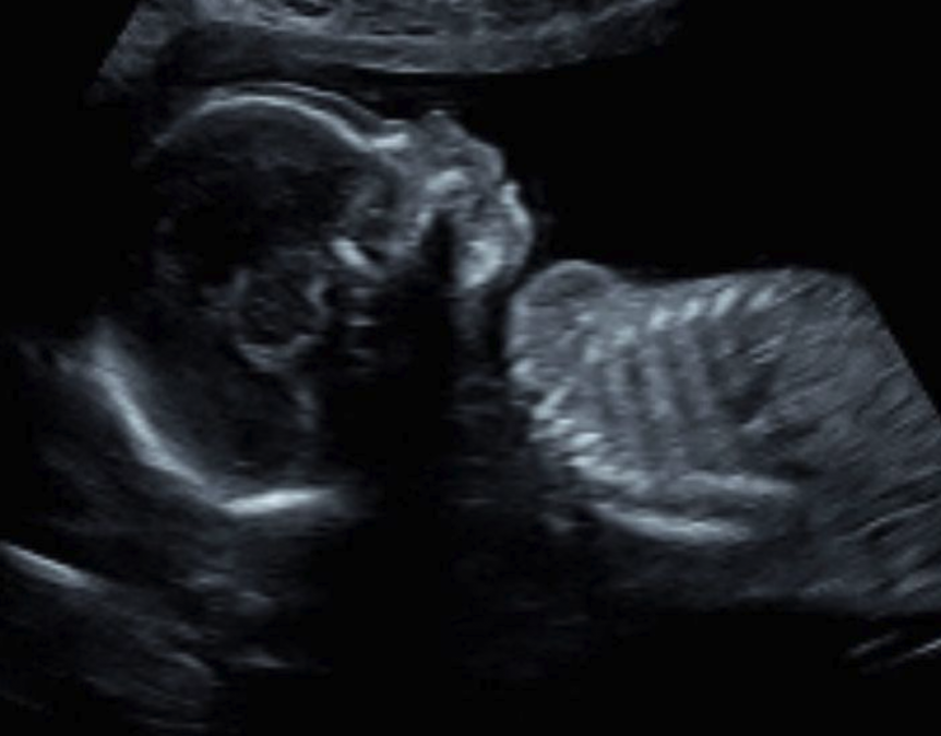 honey badger baby ultrasound nick cummins